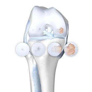 Illustration der Anatomie des Knies bei einer vorliegenden Kniearthrose, inkl. der vier Stadien.